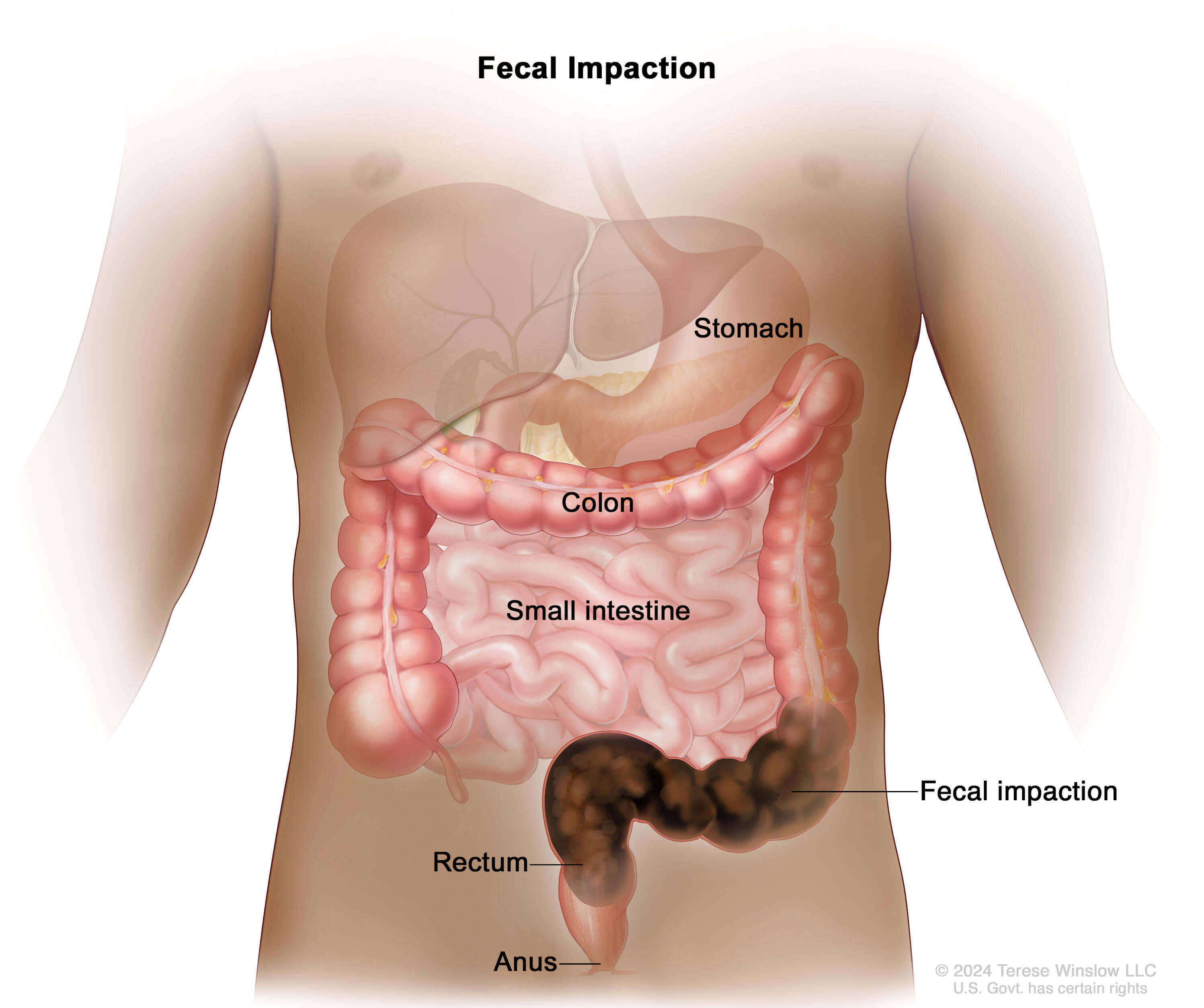 FecalImpaction_i5mjc_2995