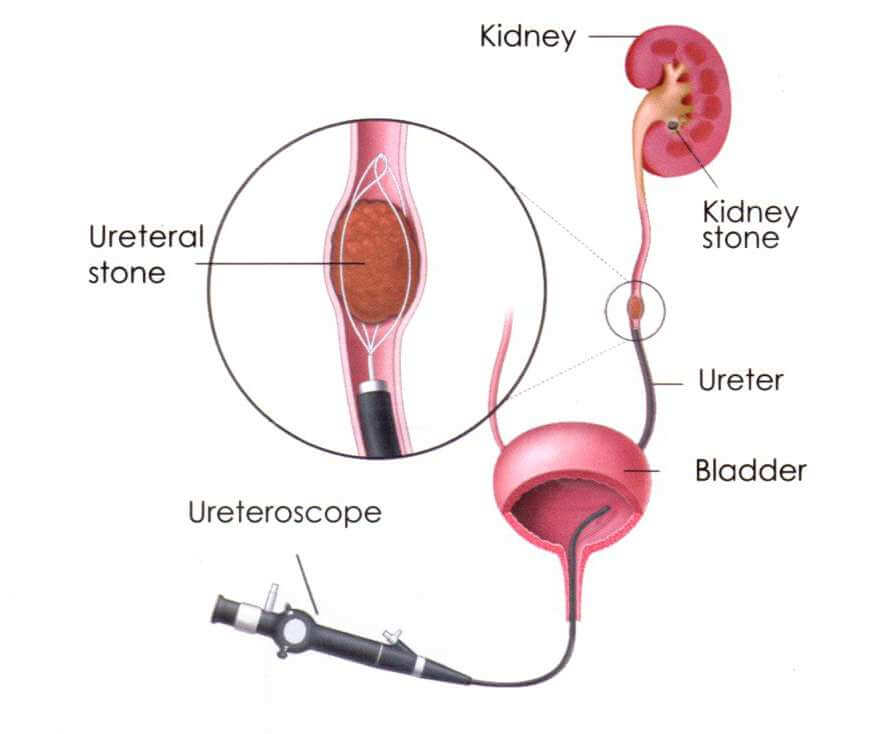 endourology_e5ndu_869