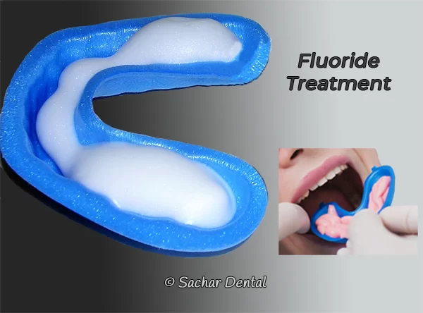 DENTISTNYCFluoridetreatmentp01v01W6001_u5mtc_600