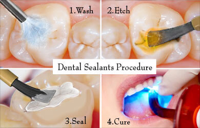 DentalSealants1_mznzm_390