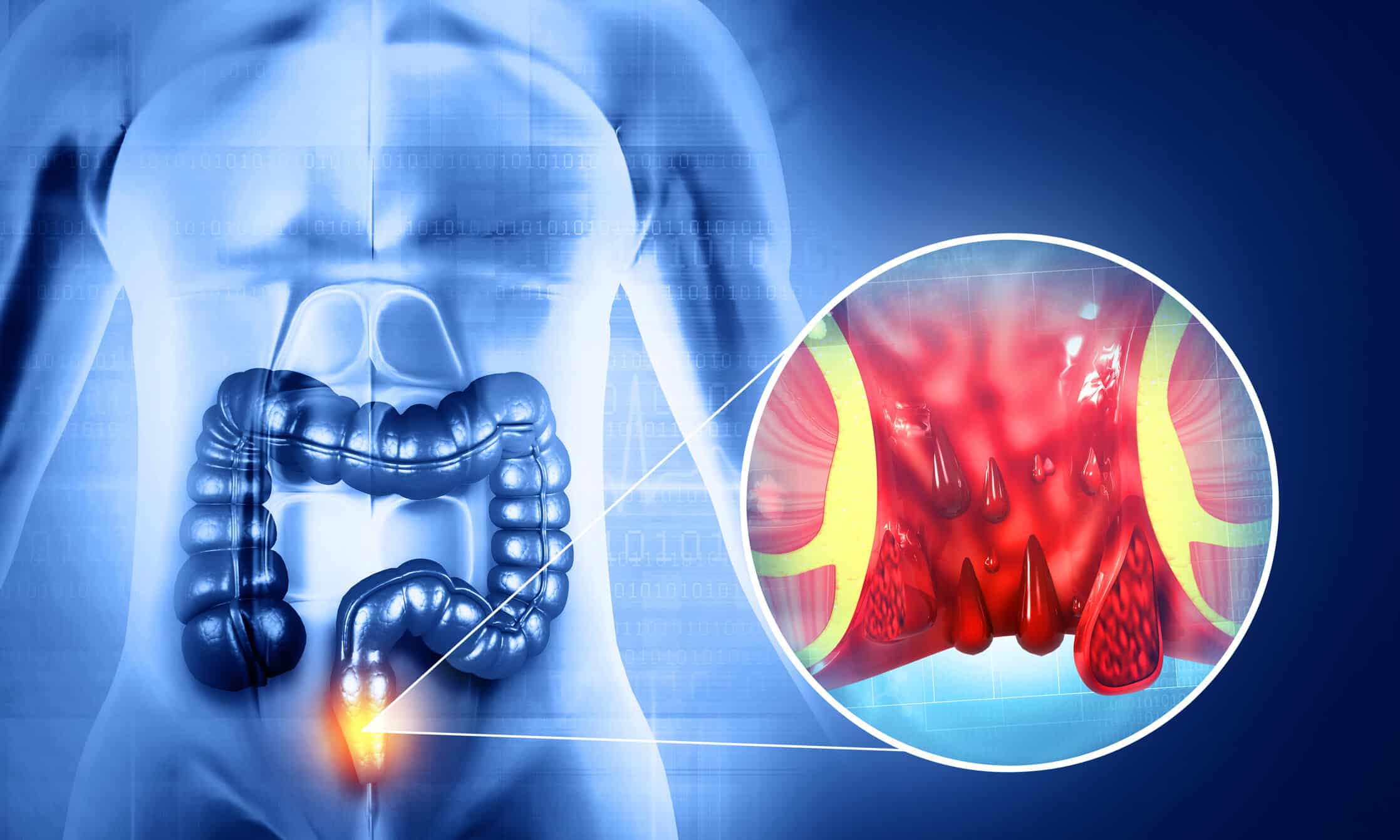 HemorrhoidArteryEmbolization_i5njy_2235