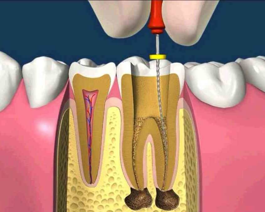 Pulpectomypulpotomyproceduresrootcanalofmilkteeth845x676_i0mda_845