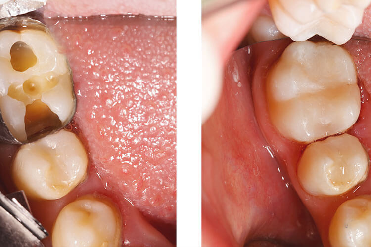 cavitydentistclaytonga_g0mde_750