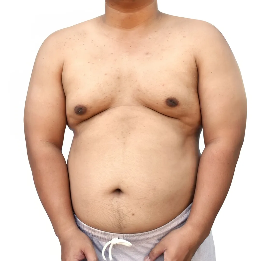 Gynecomastia_m0mty_1080