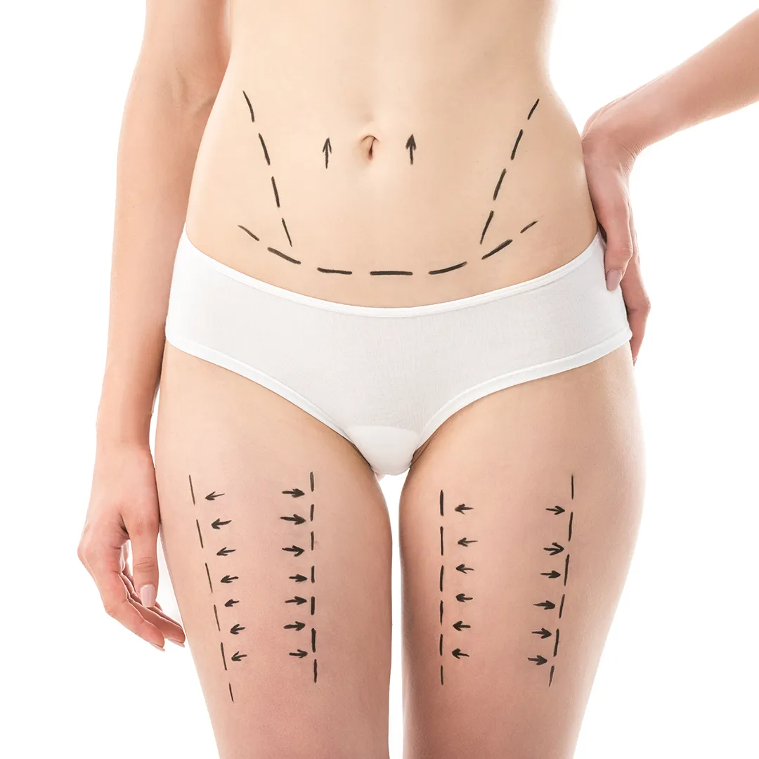 Liposuction1_yzody_1080