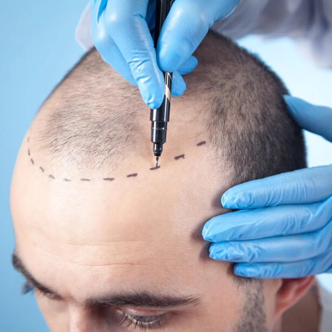 hairtransplant_gzmdk_1080