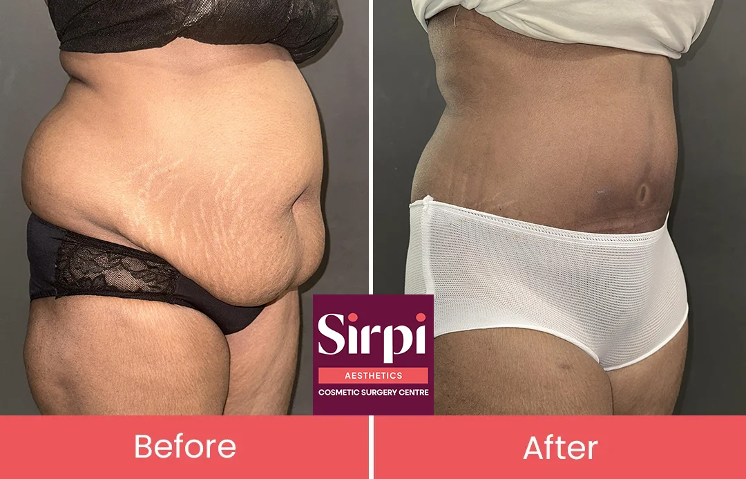 tummytruckbeforeaftercopy_cwodk_1080