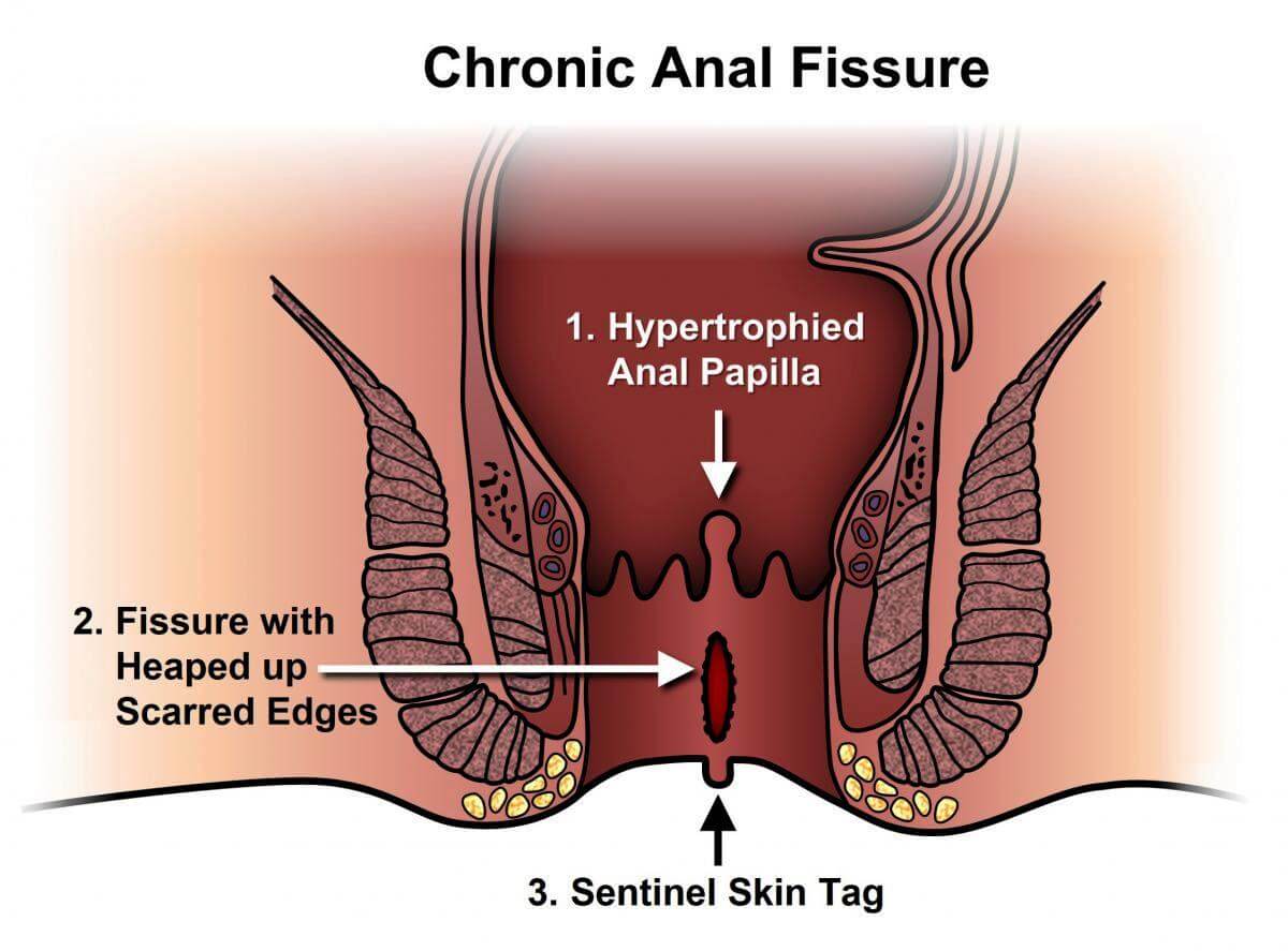 AnalFissureSurgeoninPune_c2mdi_1200