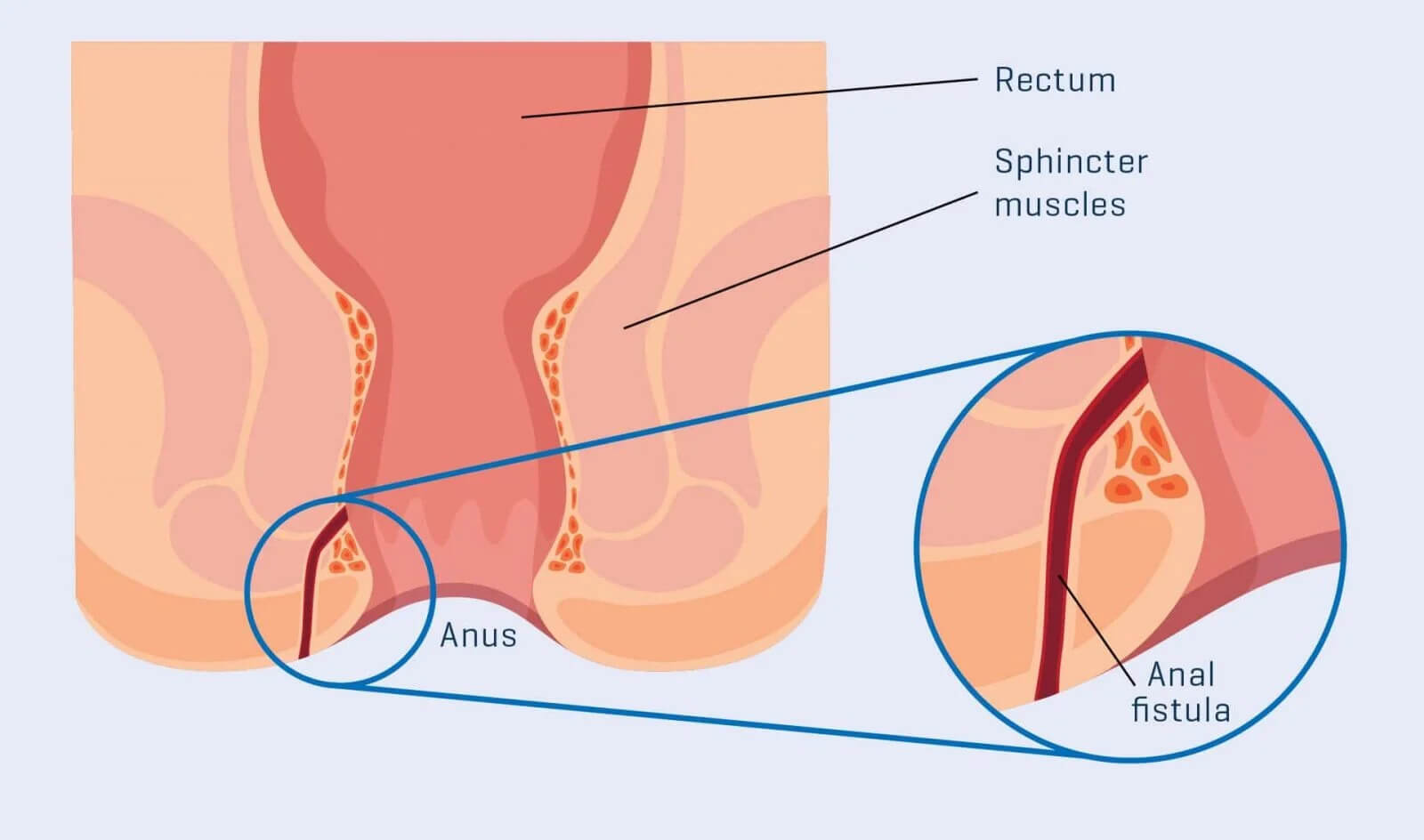 AnalFistula1600x11891e1678435877307_c2mjg_1600