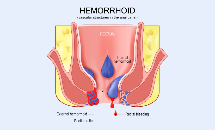 haemorrhoids_y1mje_825
