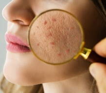 Acne understanding