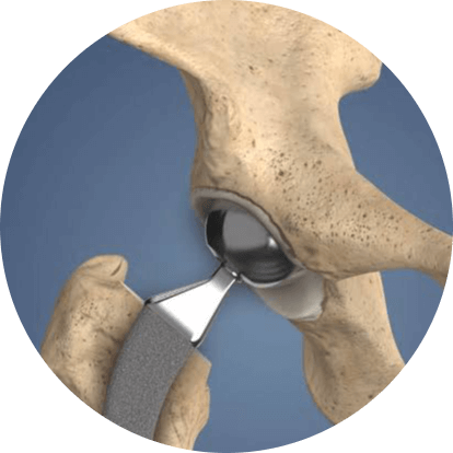 hipreplacemodified_axndk_414