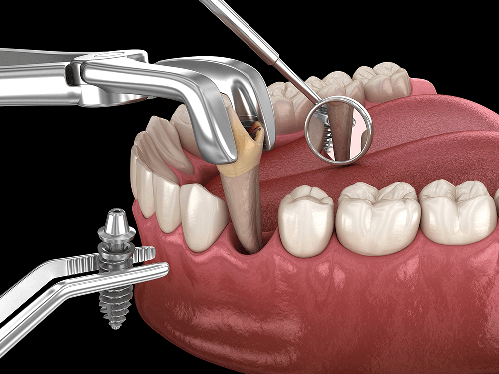 Dental Extraction Training