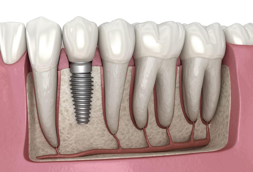 i4mtk_1000_Dentalimplantillustration