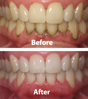 ixmda_285_Periodontalbeforeafter01