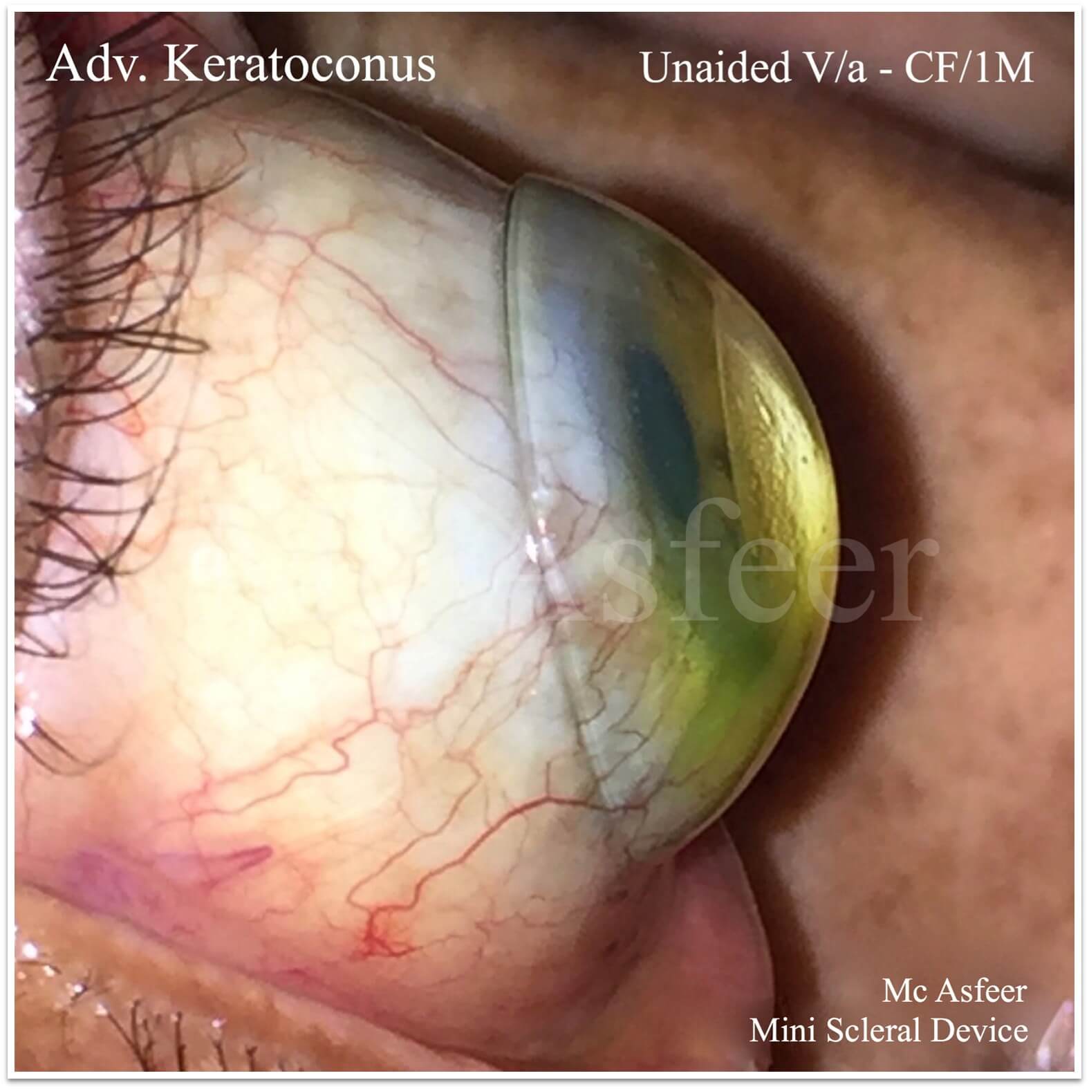 kcscleral_ewmzu_1575