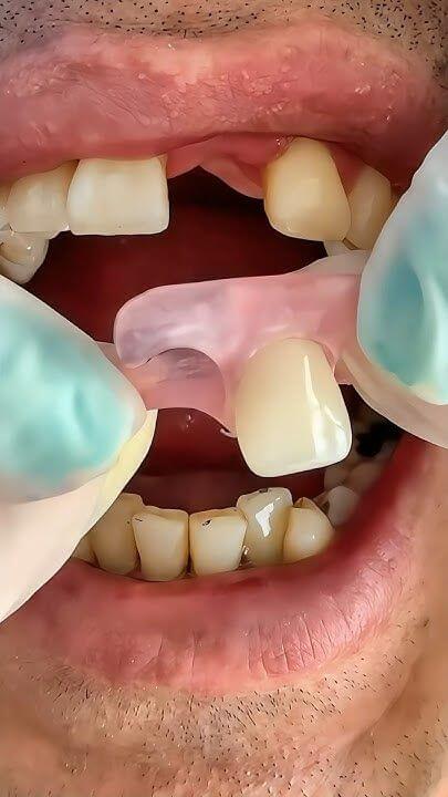 DentalProsthesisInventionRevolutionizedHistory_pisdx_405
