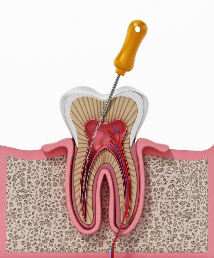 WhatIsRootCanalTherapy_zqbnf_735