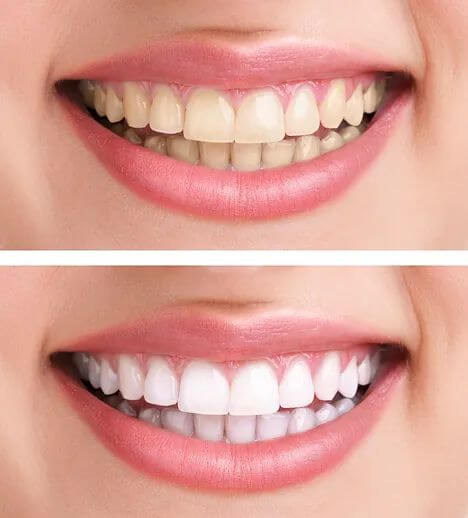 WhiterTeethBrighterConfidenceArlington_0s5n9_468