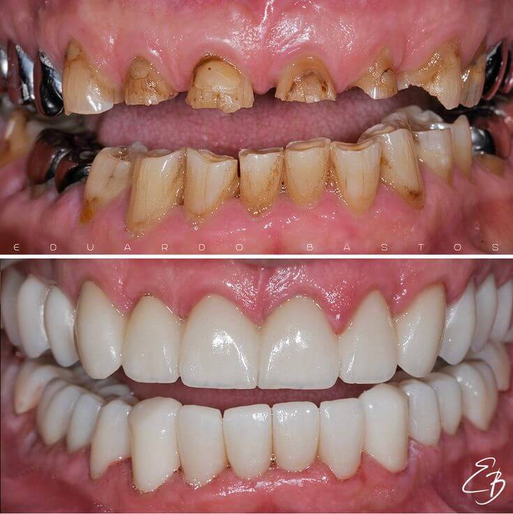 bruxismdentistrydentisttmjtmjdisorderodontologiatoothwearteethsmilemakeoversmilecrownsdentalcrownsdentistrycosmeticdentistrydentalbeforeandafter_v6q8c_735