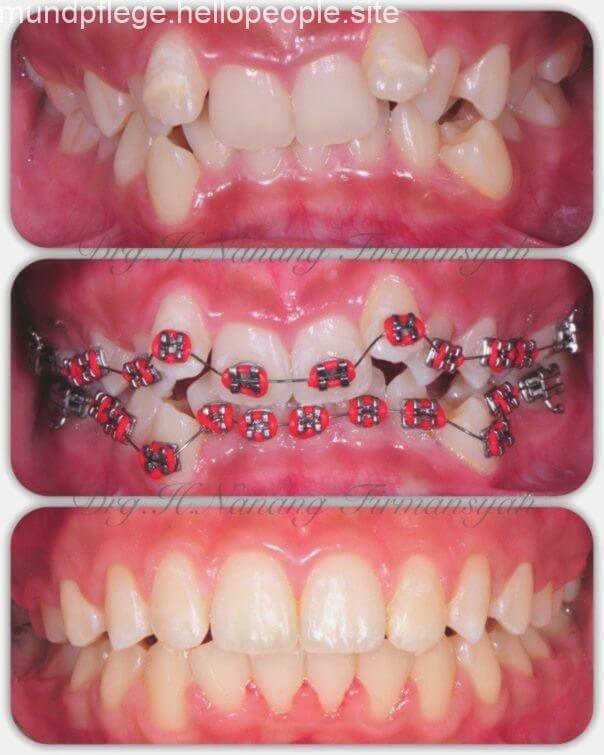 transformationbracesbraces_kxfc9_604