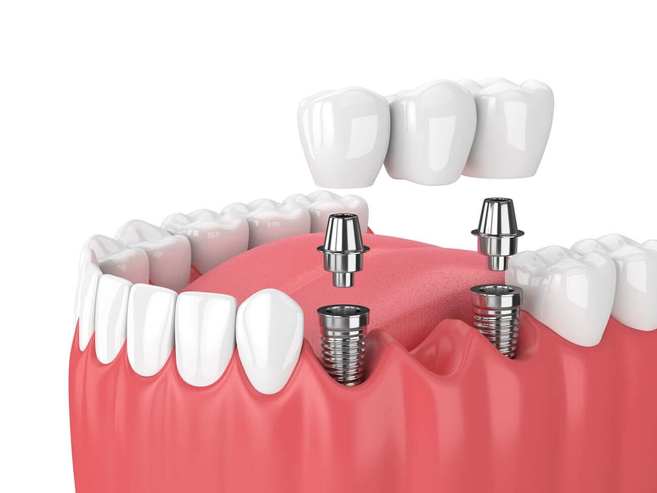 a5mde_1300_TypesofDentalImplants