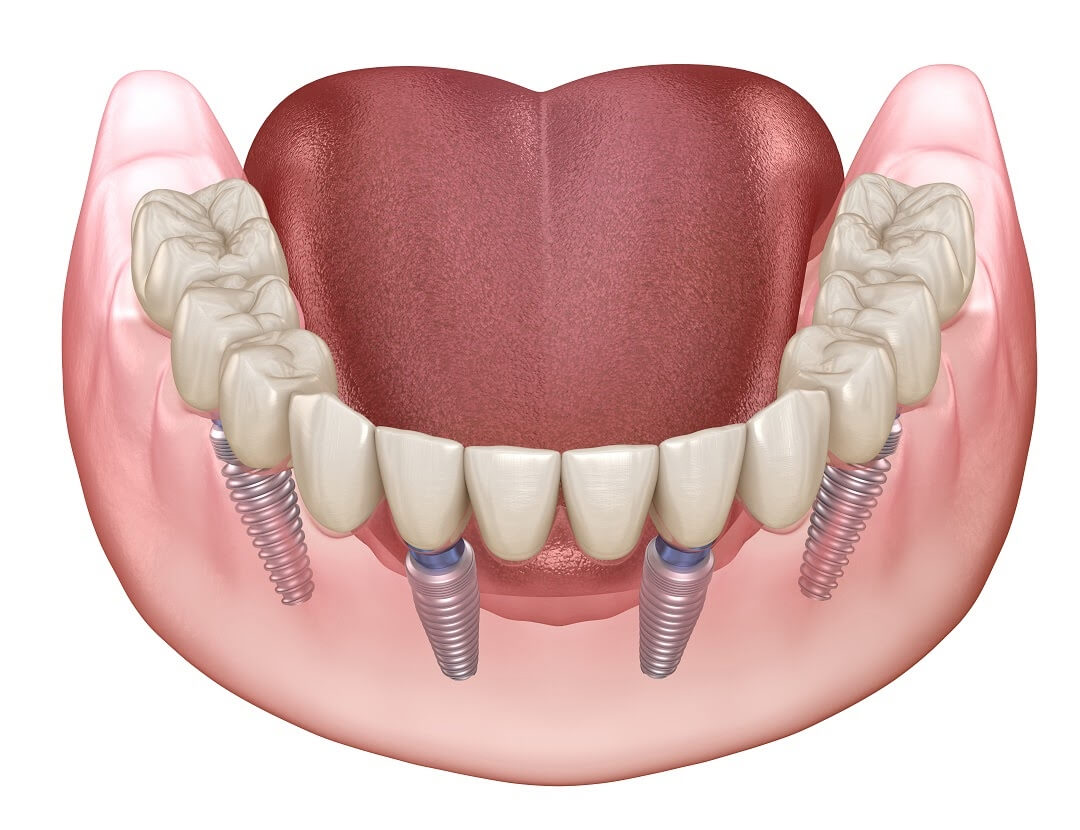 g5ntc_1080_FullmouthRehabilitation