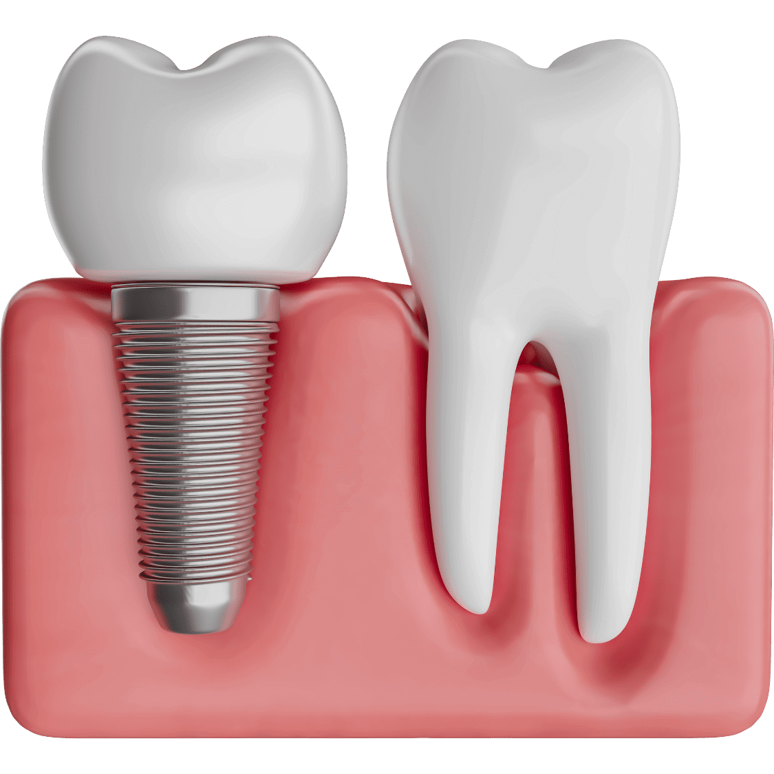 DentalImplants_c2mdm_1125