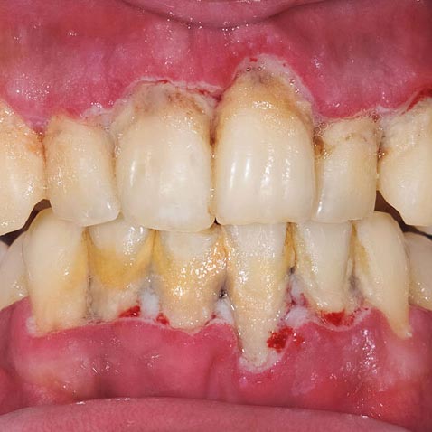 kynzi_478_signsofgumdisease