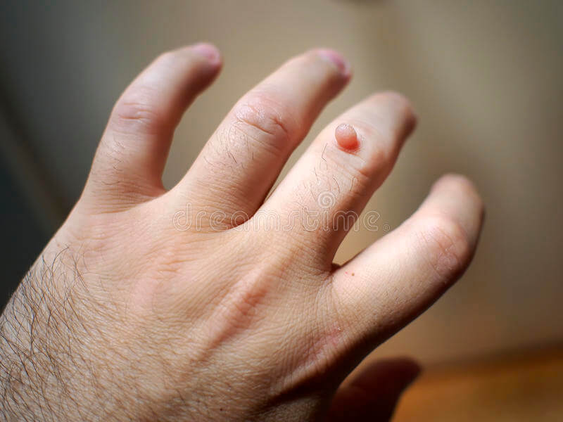 c3ntu_800_wart