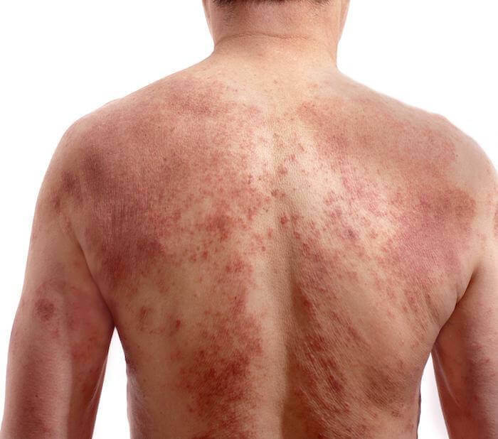 y5nzu_700_g5ndu700allergy