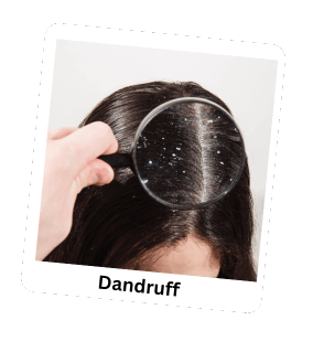 Dandruff_gzmzg_284