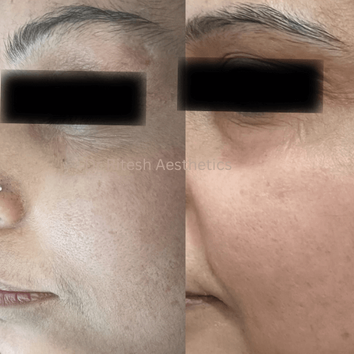 i4mze_500_DrRiteshAesthetics