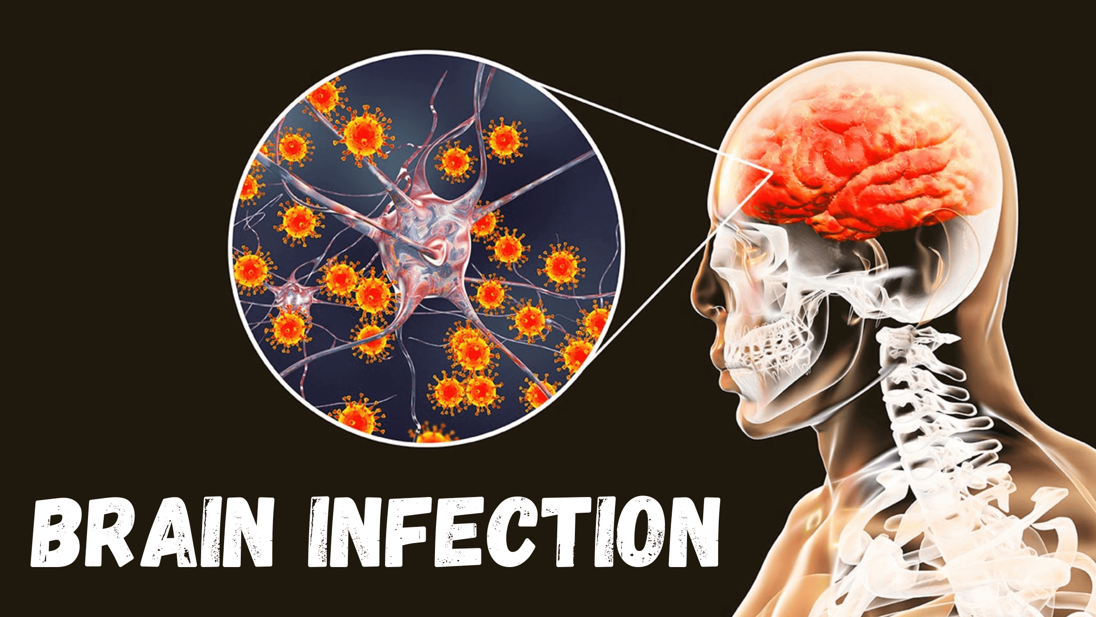 BrainInfection1min1_m5nzc_2240