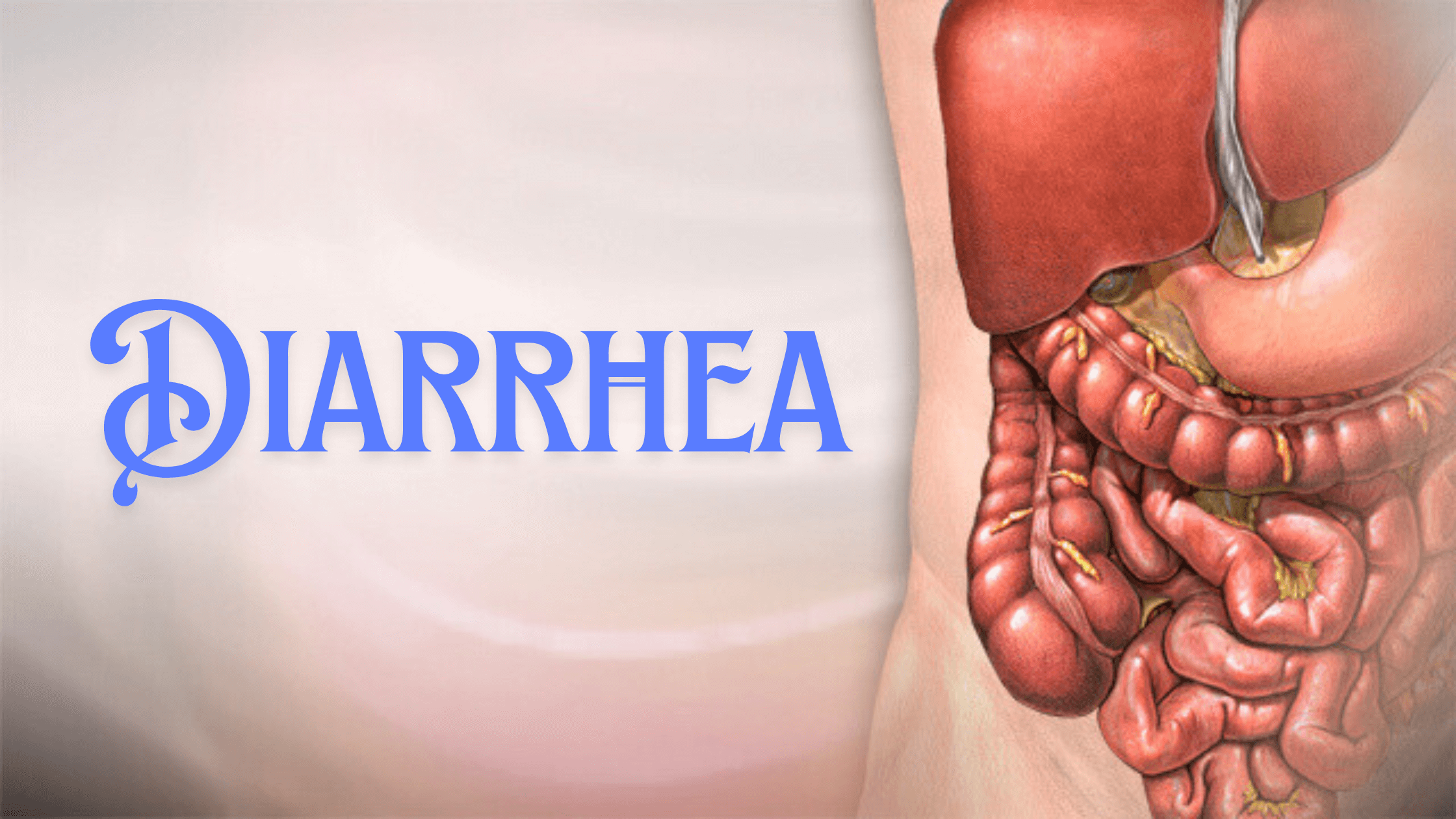 Diarrhea2_i1mtq_2240