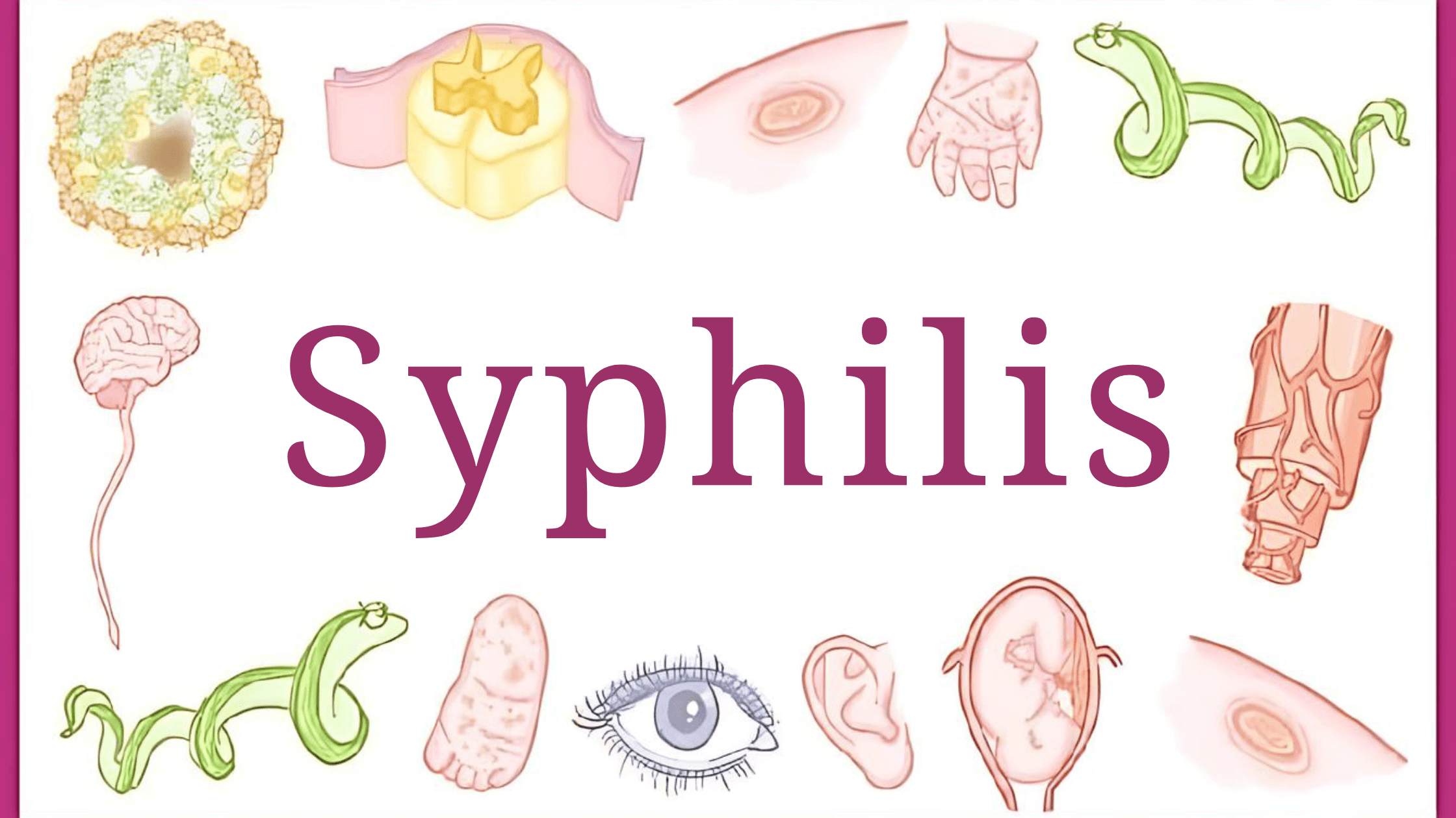 Syphilis_k5nty_2240