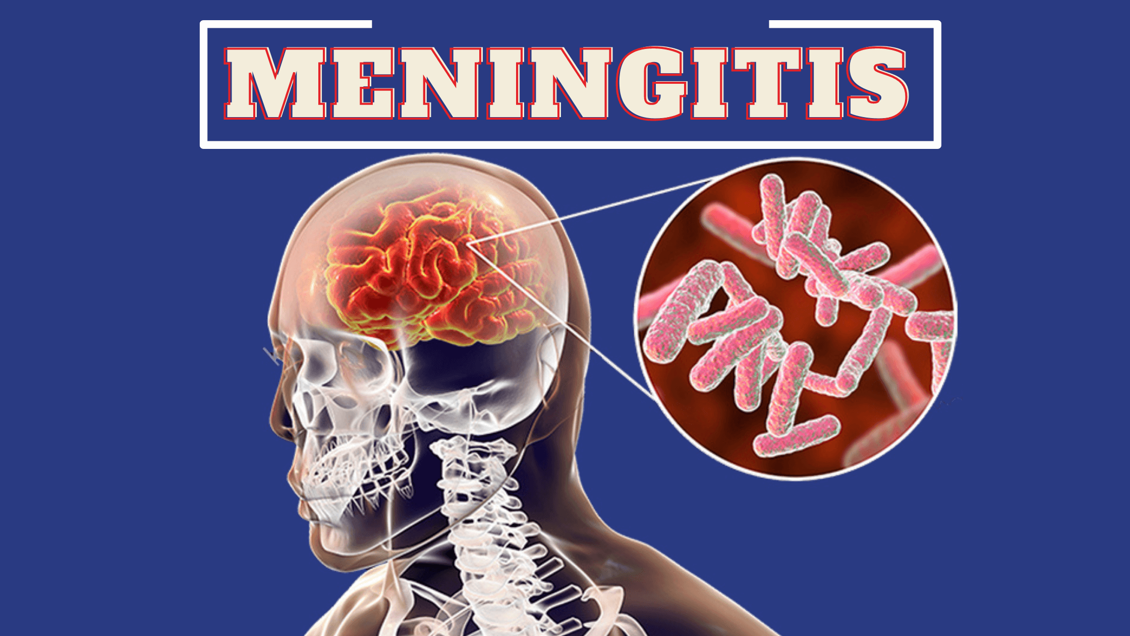 a1ntq_2240_meningitis1