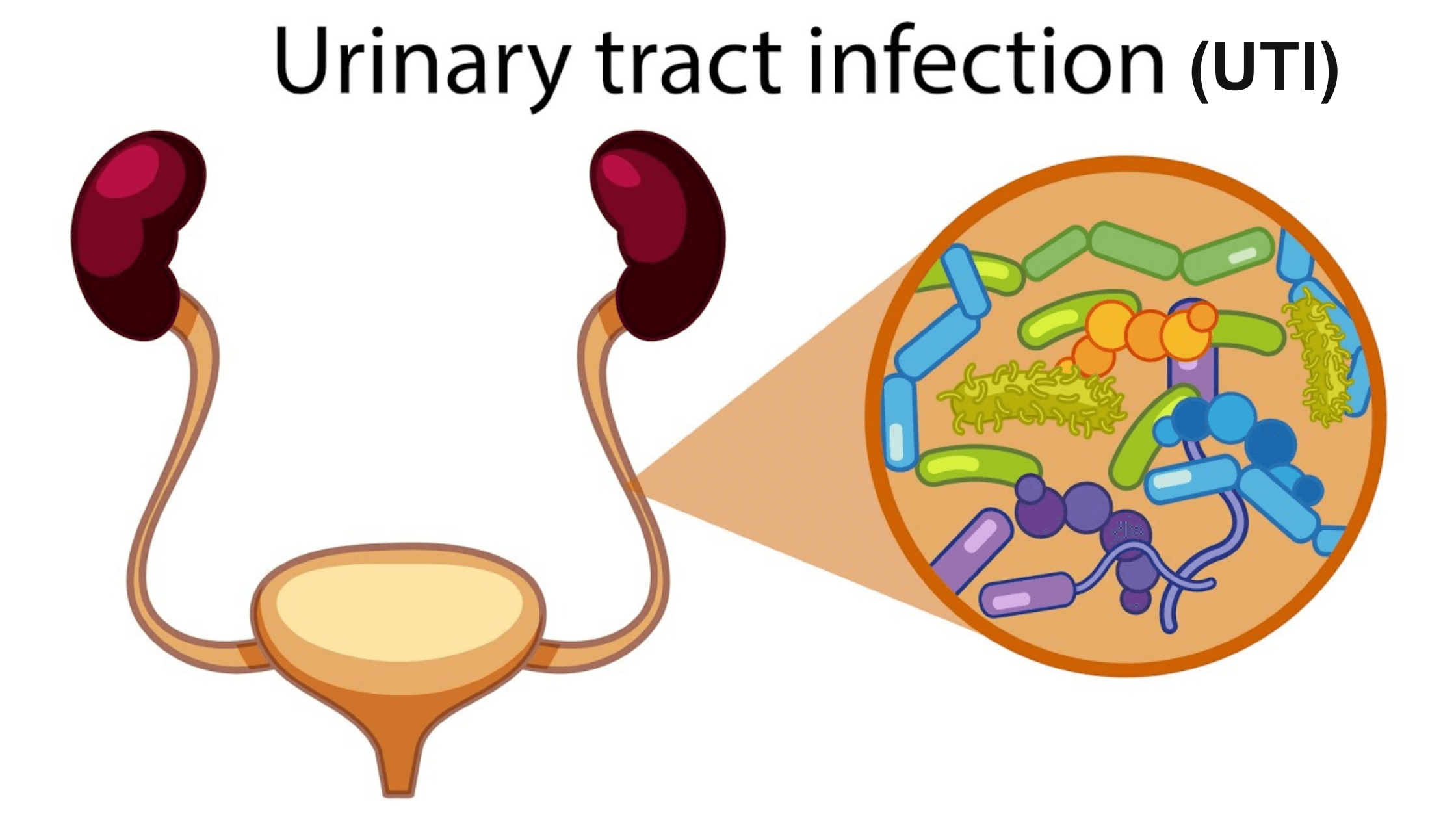 axndg_2240_UrinaryTractInfectionUTI3