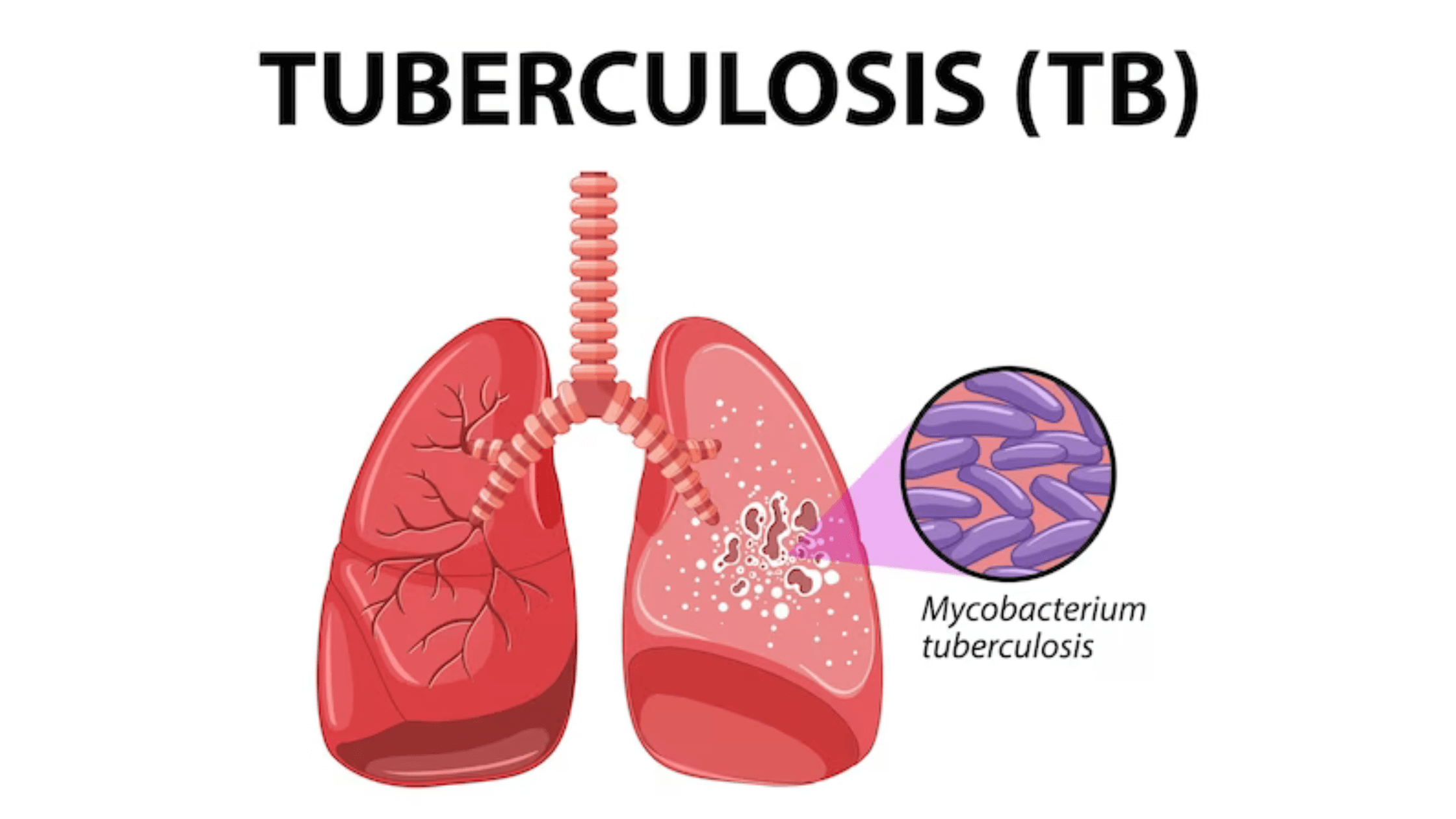 k4oty_2240_TuberculosisTB2