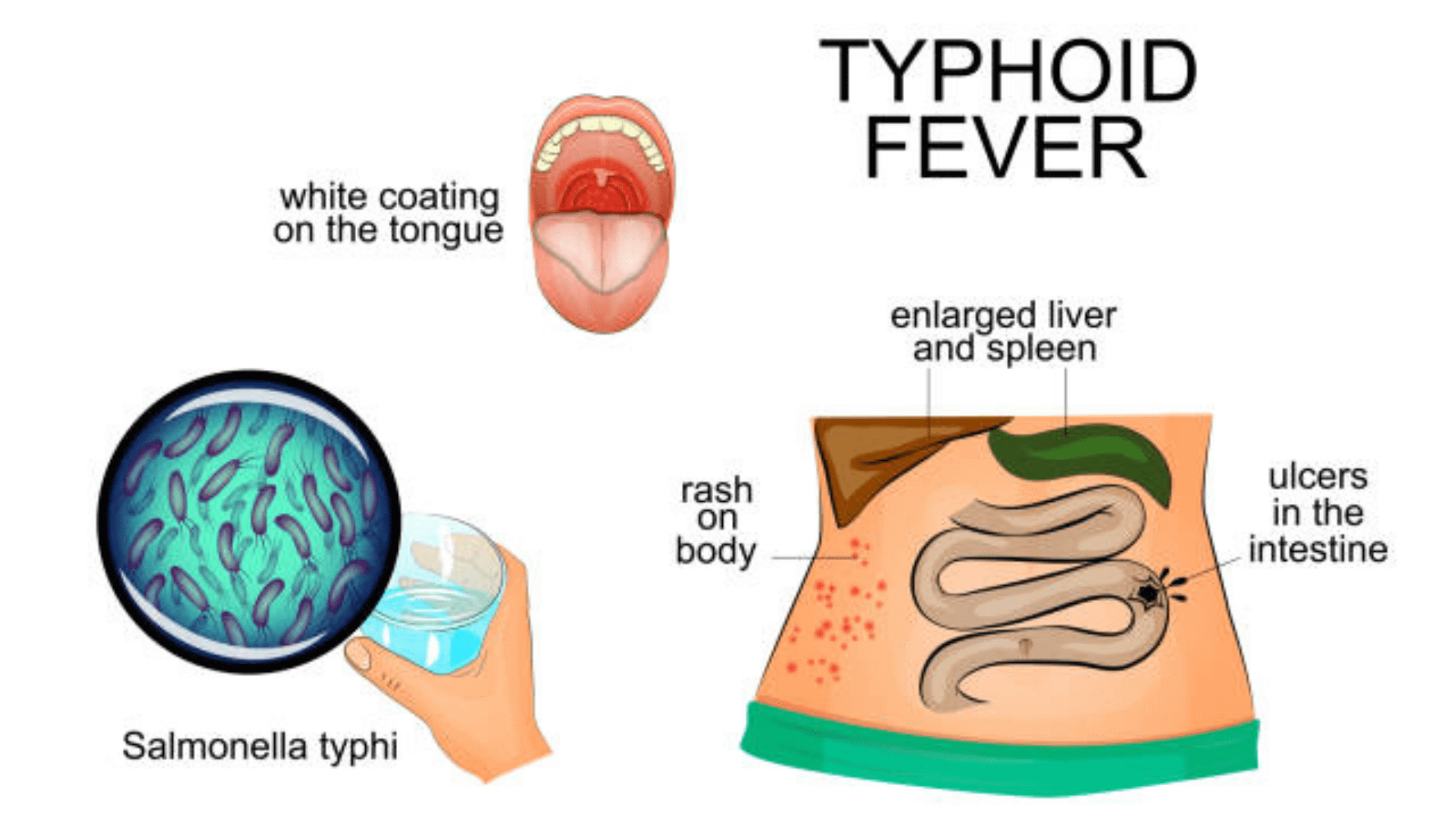kynzm_2240_Typhoid1min