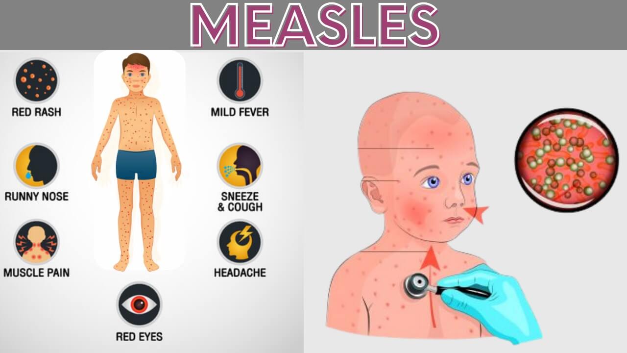 measles