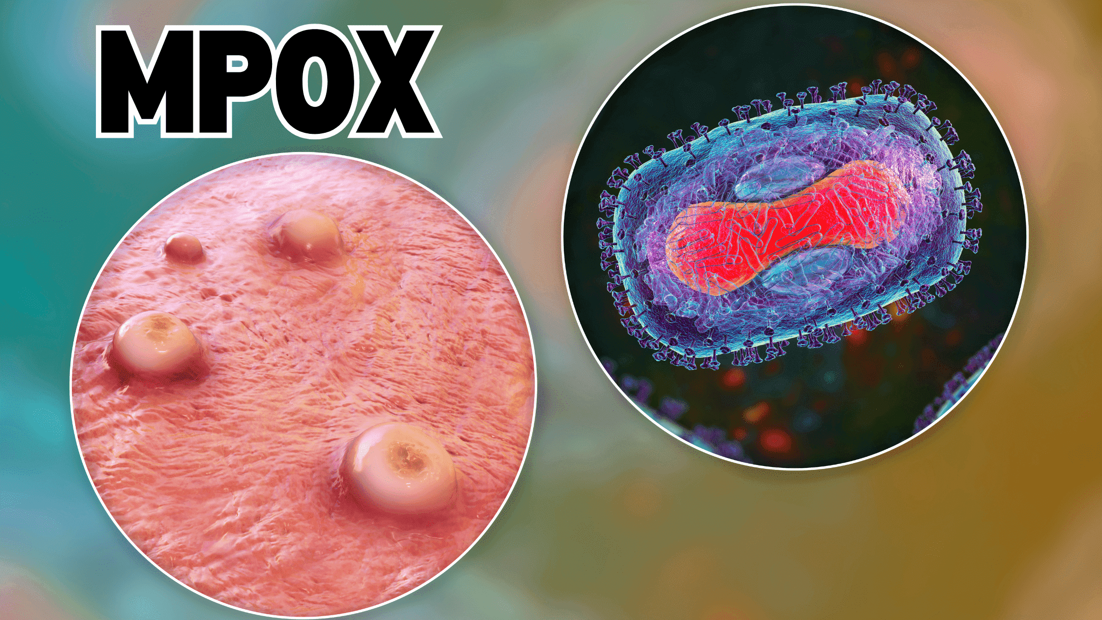 mpox2minminmin1_m0ndg_2240