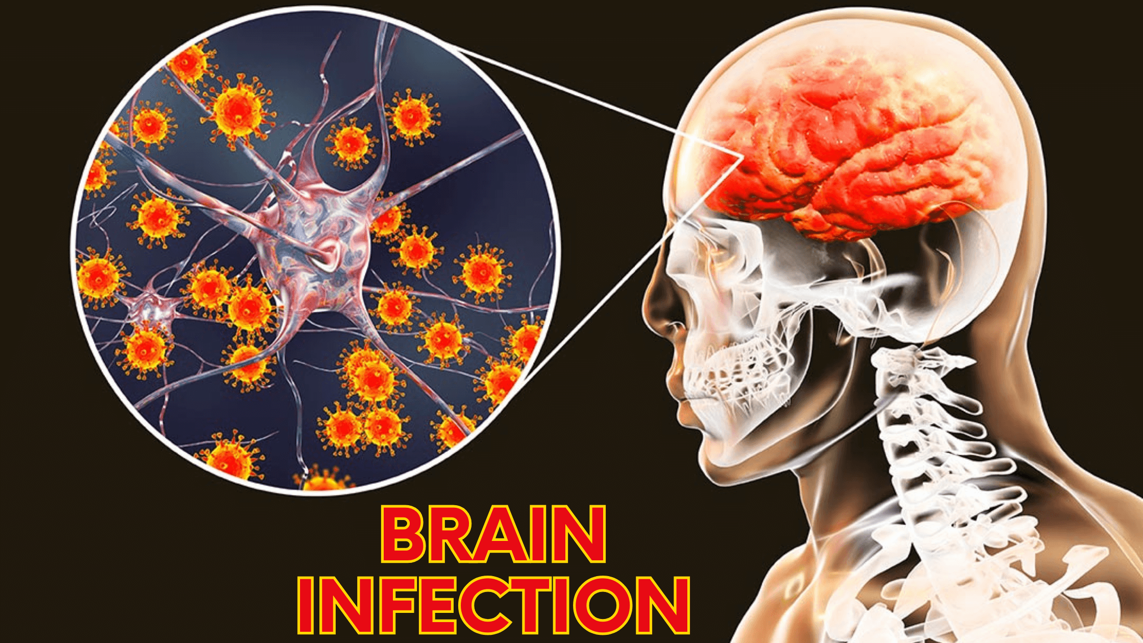 mxnjk_2240_BrainInfection2
